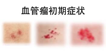 <strong>血管瘤最初小红点图片，在江苏哪家医院可以去除胎记？</strong>