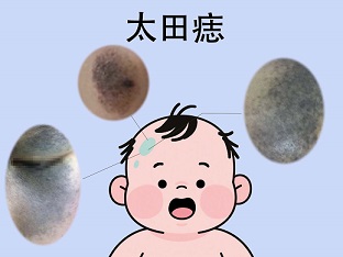 <strong>太田痣会遗传给孩子吗？江苏哪家医院看胎记口碑好？</strong>