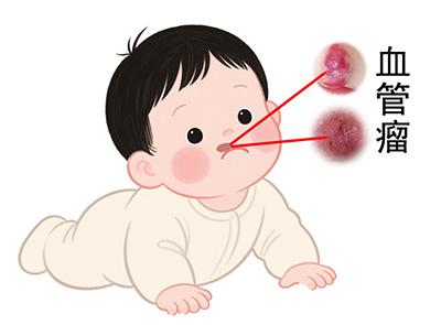 <strong>皮肤百科：宝宝血管瘤涂药膏能好吗？需要吃口服药吗？</strong>