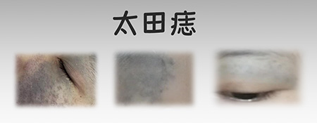 <strong>健康指南丨太田痣治疗后红肿怎么办？如何护理？</strong>