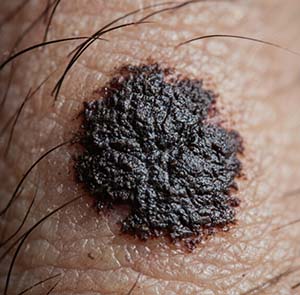 <strong>胎记解读丨黑毛痣会越长越大吗？宝宝多大停止生长？</strong>