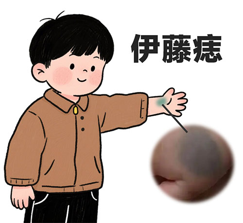 <strong>胎记讲堂丨伊藤痣形成原因是什么？与什么有关？</strong>