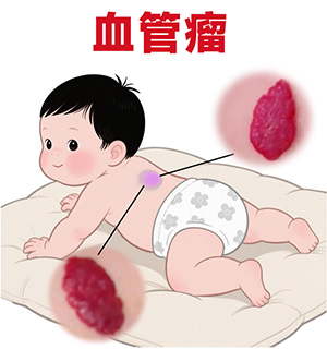 <strong>【皮肤科普】哪种血管瘤必须治？长在哪些部位很危险？</strong>