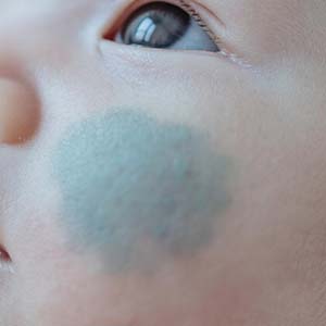 <strong>宝宝长了太田痣，这5个护理要点别忽视！</strong>