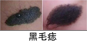 <strong>后背有块黑色胎记？上面长了几根毛，可能是黑毛痣！</strong>
