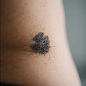 <strong>黑毛痣会遗传吗？家里有人有，孩子要注意什么？</strong>