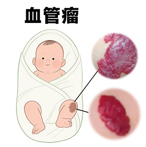 <strong>[在线咨询]血管瘤长得像草莓，当心「快速增殖期」！早治能避免破溃…</strong>