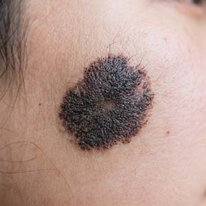 <strong>【治疗选择】黑毛痣是切还是激光？看大小和深度...</strong>