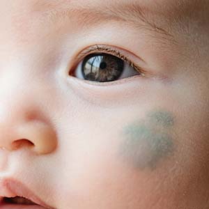 【皮肤知识】太田痣能自行消退吗？别抱侥幸心理...