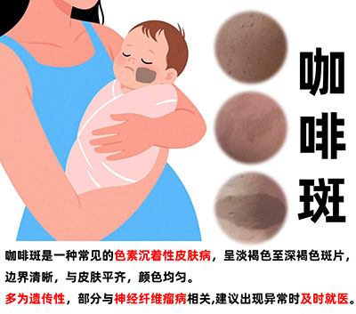 <strong>【咖啡斑快速新增或增大】 可能是内在疾病活动的征兆</strong>