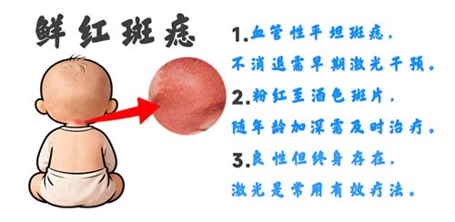 鲜红斑痣不治疗会引发青光眼吗？南京胎记专科医院哪家好？