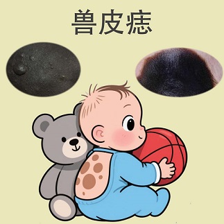 兽皮痣和黑毛痣极易混淆，具体区别在哪里？